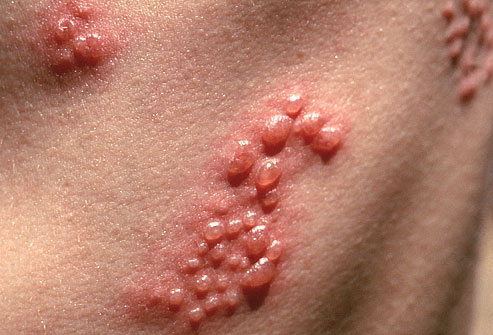 What Causes Shingles?
