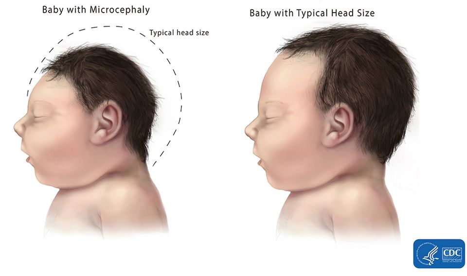 Microphaly comparison