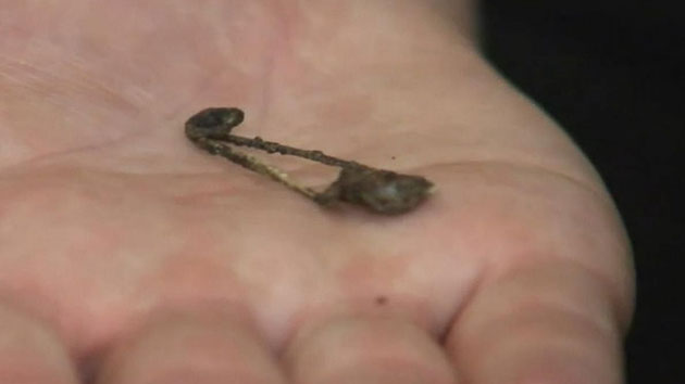 Five-year-old had safety pin stuck up nose for six months